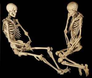 Figure 7: Fibrodysplasia ossificans progressiva, Harry Brookes Allen Museum of Anatomy and Pathology, Melbourne. Reproduced with permission.